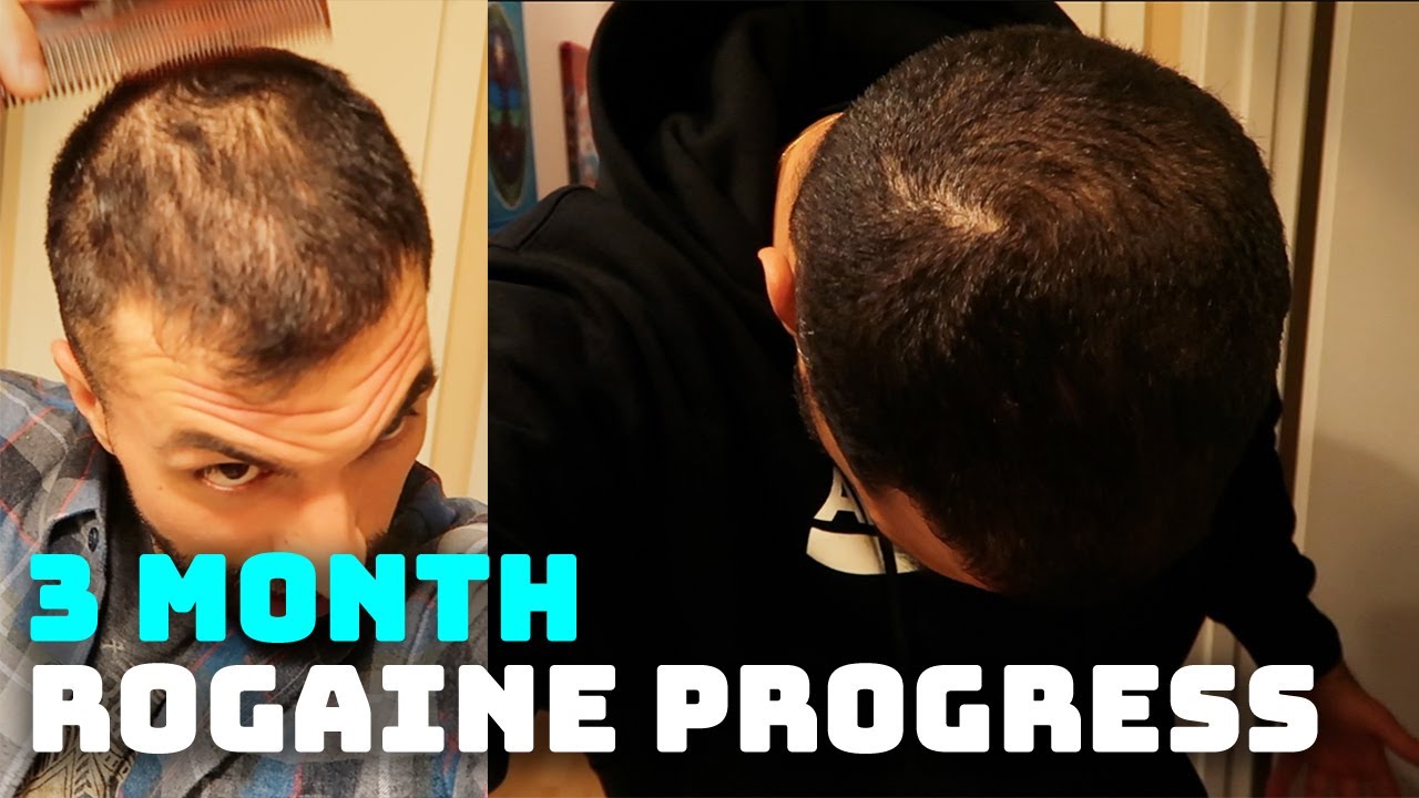 3 Month Rogaine Results and Progress (Minoxidil)