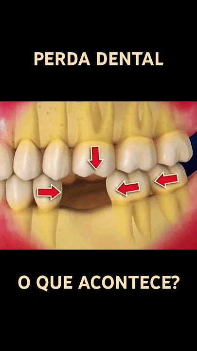 Perda Dental #shorts