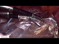 Laproscopy surgery of jaipur doorbeen hospital