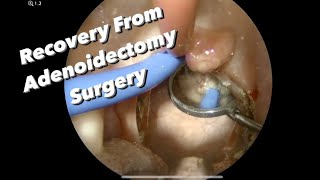 Post Op Adenoidectomy:  how much pain, what not to eat, what activities to avoid, when is post op