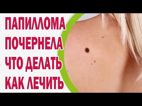 От чего возникают папилломы на шее