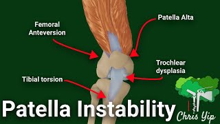 Recurrent patella instability (Animated) screenshot 4
