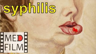 Syphilis. Gonorrhea. Sexually Transmitted Diseases (subtitles available) © Венерические болезни