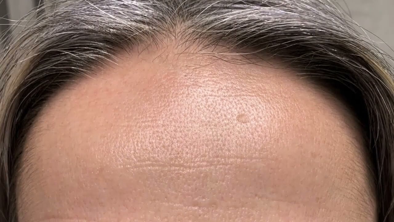 Botox Panna Örebro Estetik