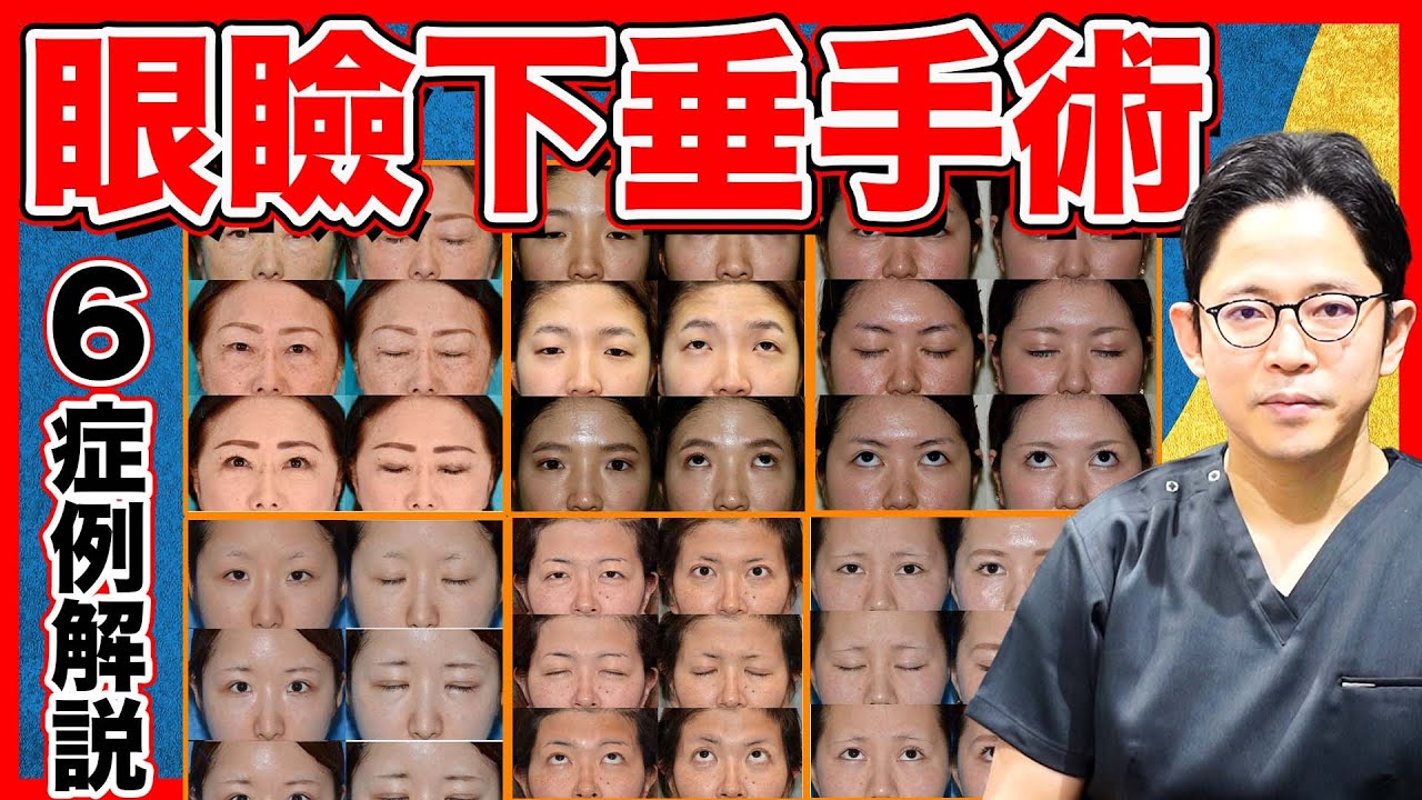 眼瞼下垂症例解説