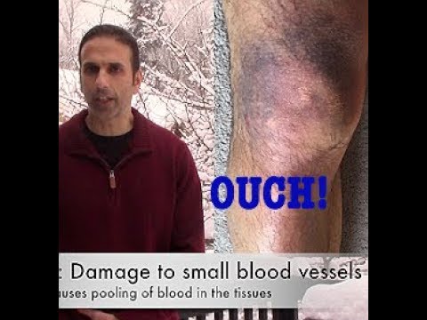 Video: Hematoma On The Leg After A Bruise: Home Treatment
