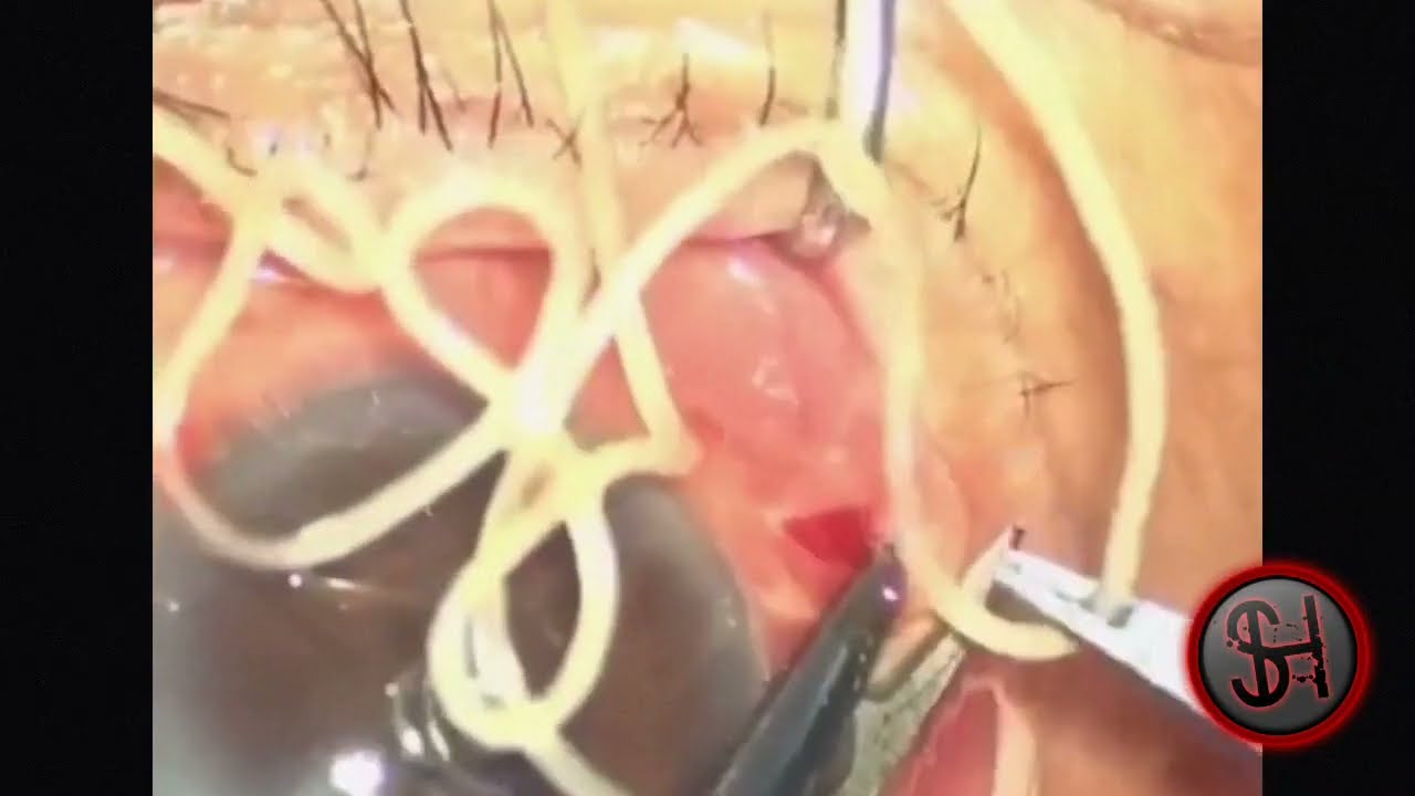 Глазной червь