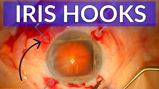 IRIS HOOKS -  Top Tips in Cataract Surgery