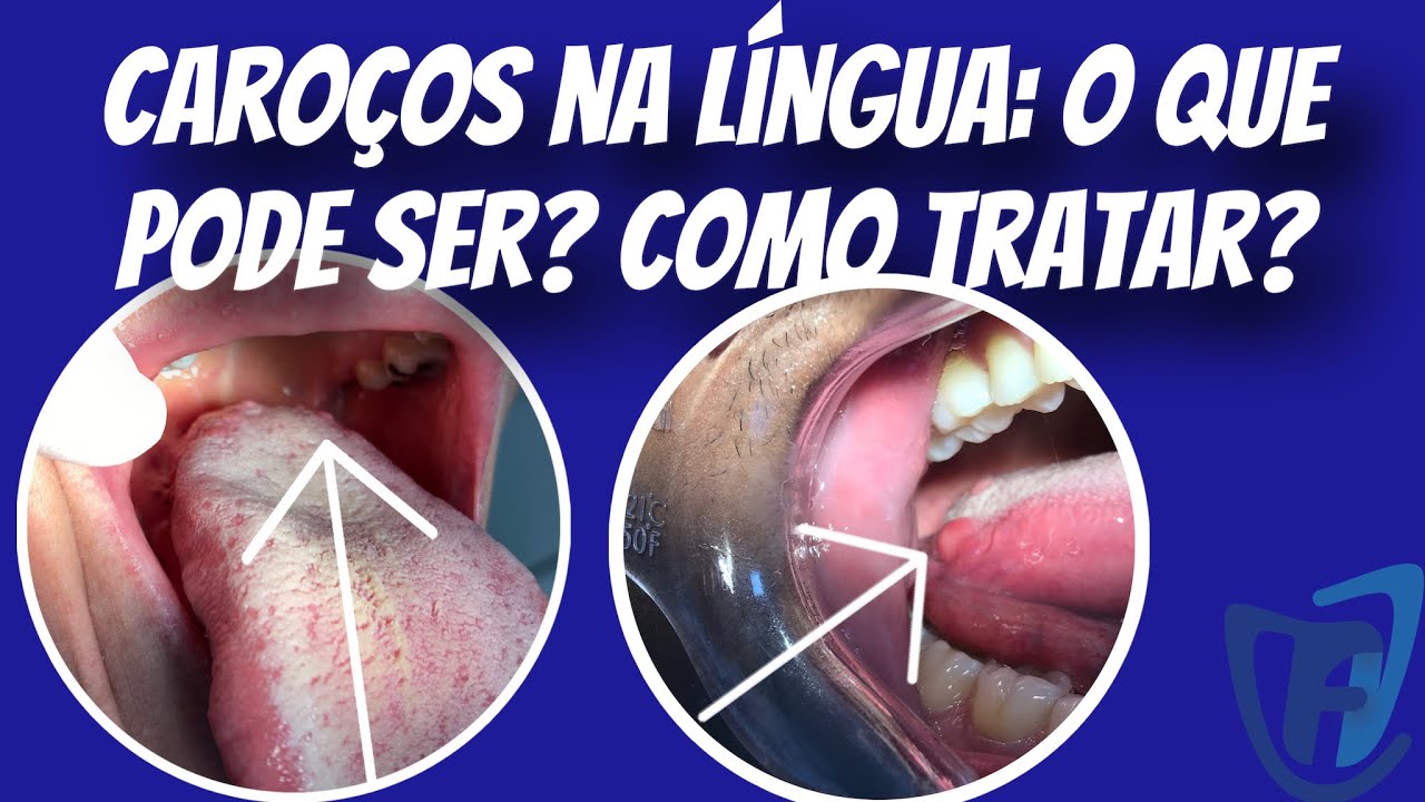 Caroço na língua: O que pode ser? Como Tratar? #estomatologia #línguas