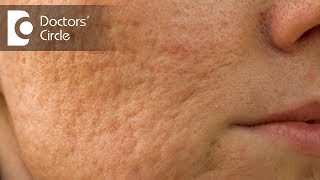How to remove Acne scars by natural remedies? - Dr. Chetali Samant