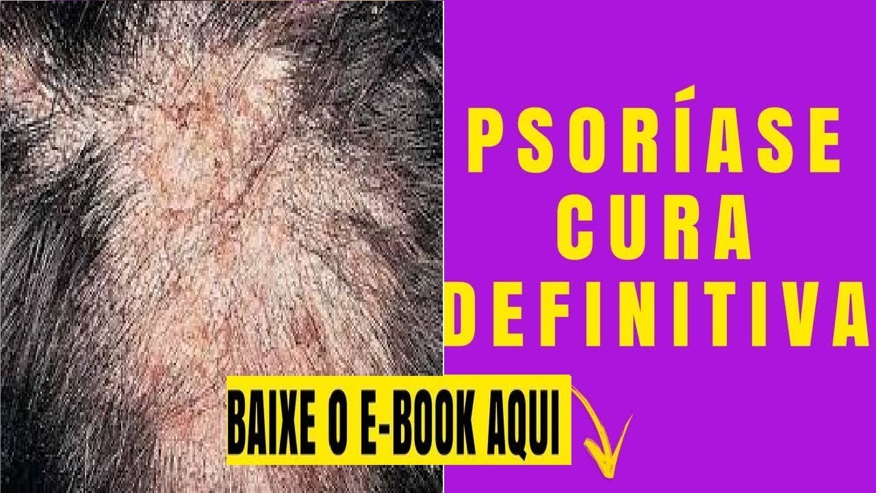 Psoriase No Cabelo Tratamentos Para Psoríase No Couro Cabeludo Youtube