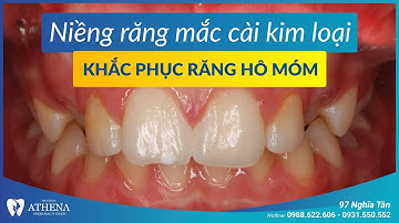 Niềng răng mắc cài kim loại - khắc phục răng hô móm 1 | Nha khoa quốc tế Athena