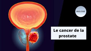 📌 Cancer de la prostate || un résumé d’une seule page ✨ screenshot 1