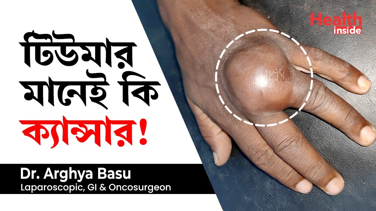 টিউমার মানেই কি ক্যান্সার, টিউমার এর প্রকারভেদ এবং চিকিৎসা | Are all tumours cancerous | tumour type