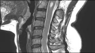 Cns C12 Cervical Spine Syrinx