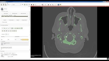 Step 1   Segment CT in Slicer