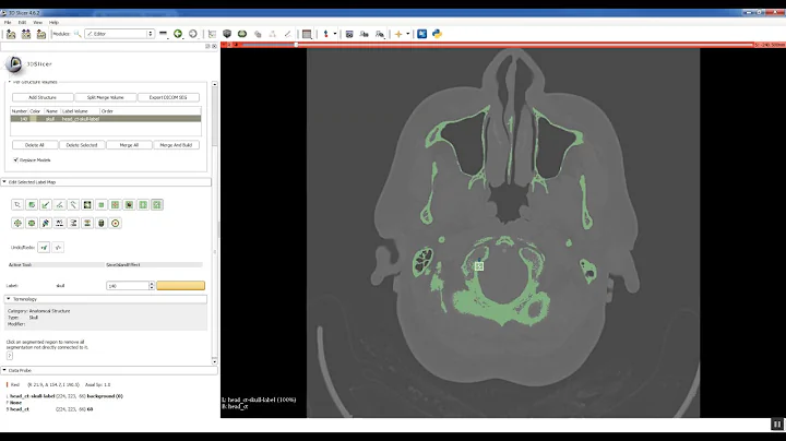 Step 1   Segment CT in Slicer