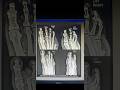 Disarticulation gangrenus toe