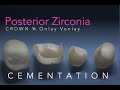 Zirconia Ceramics, Part 5: Posterior Onlay, 3/4, Vonlay and Crown Cementation