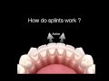 How Do Dental Splints Work