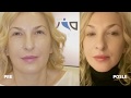 Botox - procedura koja uklanja bore i tragove vremena sa lica - poliklinika Diva