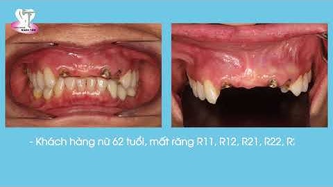 CẤY GHÉP RĂNG IMPLANT BẰNG ROBOT ĐỊNH VỊ TẠI NHA KHOA NHÂN TÂM