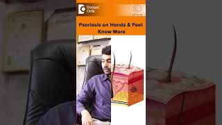 PSORIASIS on Hands & Feet |Palmoplantar Psoriasis Treatment-Dr.Rajdeep Mysore|Doctors Circleshorts