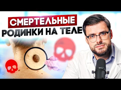 ОПАСНЫЕ РОДИНКИ: как распознать родинку вызывающую РАК?