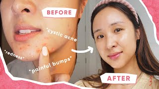 3 TIPS that CLEARED My ACNE!