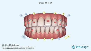 Invisalign ClinCheck®