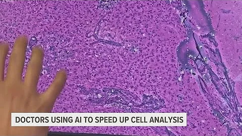 AI technology helping doctors diagnose and treat cancer faster