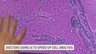 AI technology helping doctors diagnose and treat cancer faster
