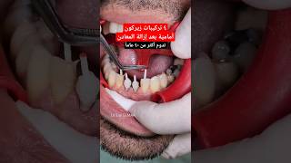 تلبيس سيراميك زيركون بعد إزالة أوتاد معدنيّة | Zirconia crown preparation