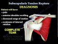 Subscapularis Tendon Rupture - Everything You Need To Know - Dr. Nabil Ebraheim