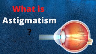 What is Astigmatism | Sight Givers