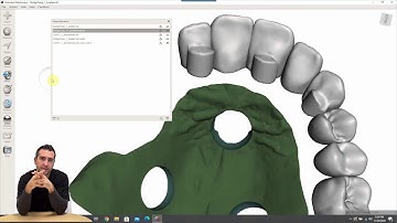 Complicated Implant planing and prosthetics in Planmeca  ROMEXIS