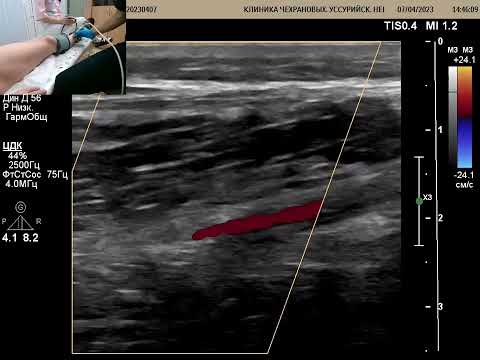 УЗИ сосудов. Определение ЛПИ ( лодыжечно-плечевой индекс)