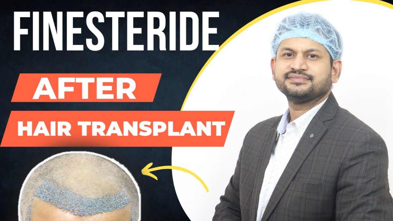 Finasteride After Hair Transplant || How to use Finasteride || Oral