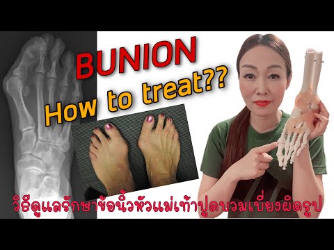 Bunionการดูแลรักษาโดยไม่ต้องผ่าตัด/ของดีออสซี่ByDrLek