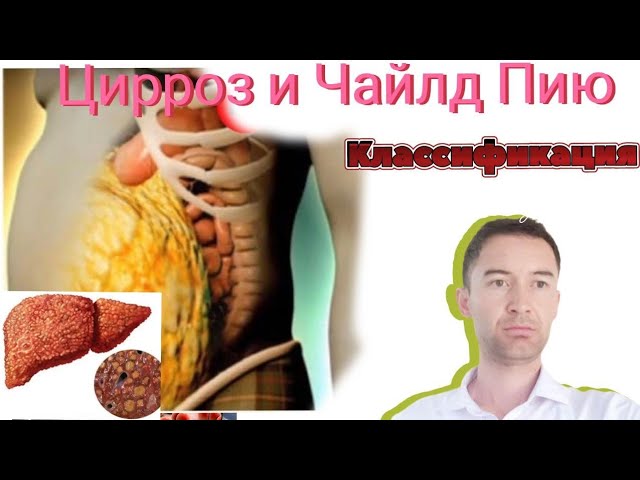 Печень увеличивается, цирроз , классификация Чайлд Пью