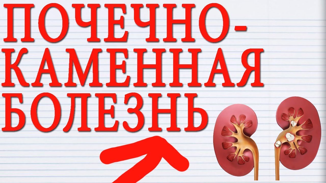ПОЧЕЧНОКАМЕННАЯ БОЛЕЗНЬ (НЕФРОТИЛИАЗ) Профилактика, Лечение, Причины ...
