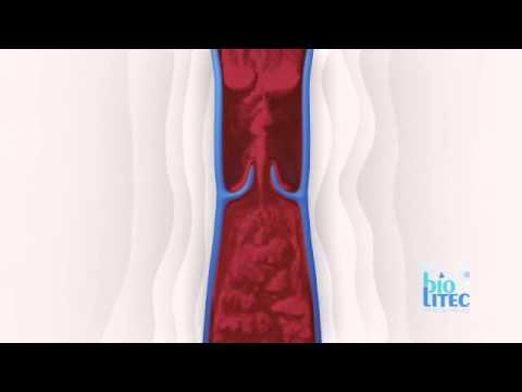 Video: Kŕčové žily: Príčiny, Príznaky A Diagnostika
