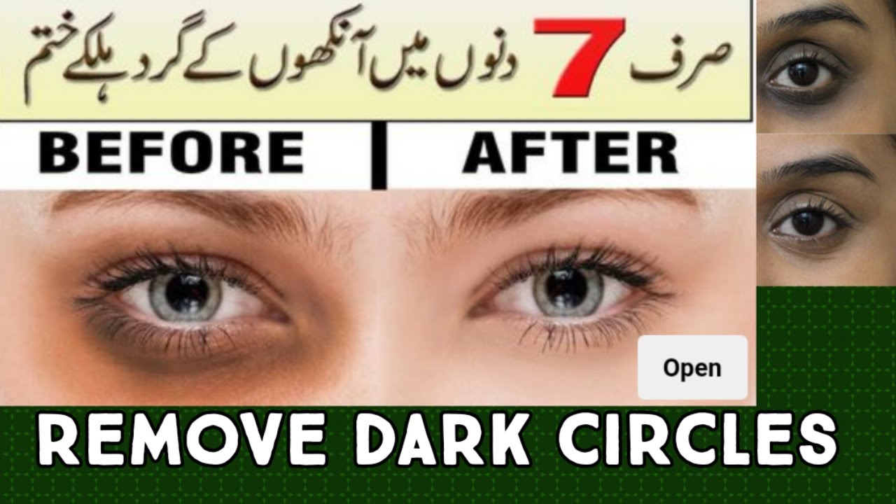 Dark circle remover /dark circles remove in 7 days by IQRA SHEHZAD