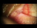 Dacryocystitis expression  infected tear duct pus explosion