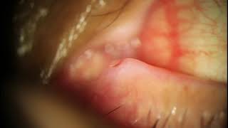 Dacryocystitis Expression - Infected Tear Duct Pus Explosion