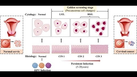 Bethesda System Classification of Cervical Precancers (Precancerous Conditions of the Cervix)