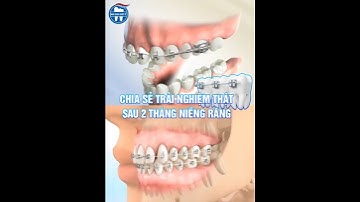 CHIA SẺ TRẢI NGHIỆM SAU 2 THÁNG NIỀNG RĂNG TẠI NHA KHOA QUỐC TẾ QUẢNG NINH  #nhakhoa  #niengrang