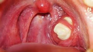 إستئصال اللوزتين | الأسباب الخطيرة لإستئصال اللوزتين Tonsillectomy