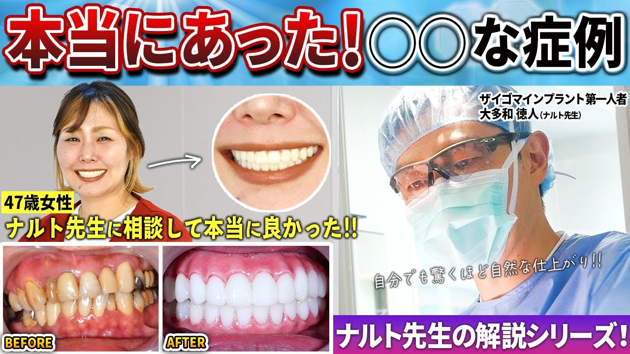 ブリッジも差し歯ももう限界です…諦めかけた女性患者をナルト先生がザイゴマインプラントで1日で治した！最高の笑顔に先生も感動した本当にあったシリーズ！