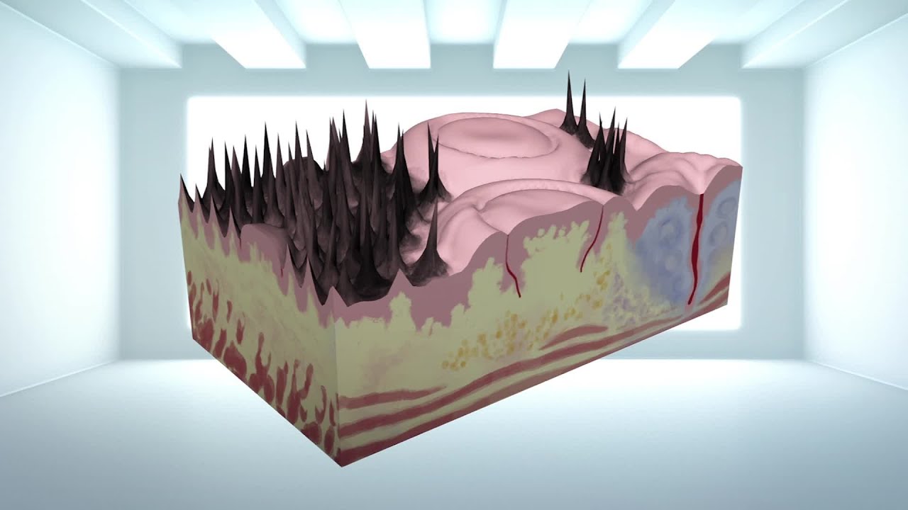 What causes 'black hair' on your tongue? YouTube